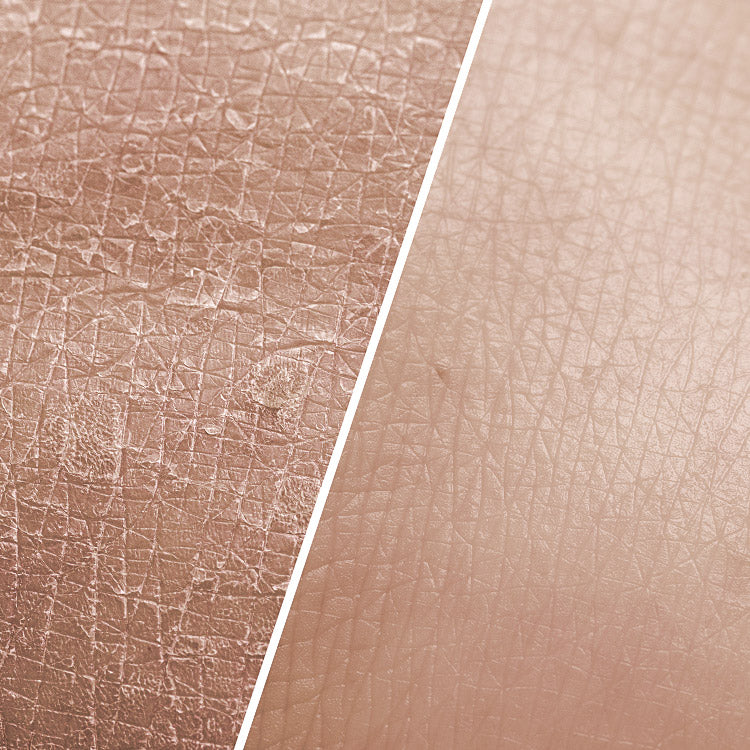 Forskellen på tør og normal hud