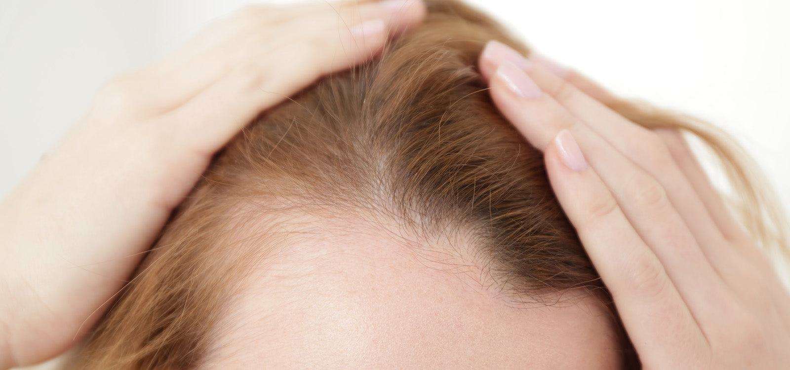 Kvinde med hårtab ved tindinger og pande, årsager og løsninger på hårtab tindinger.