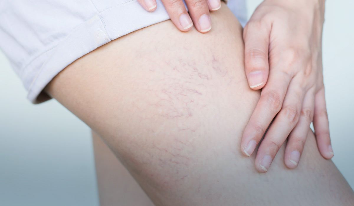 Sådan kan du få hjælp til venerne