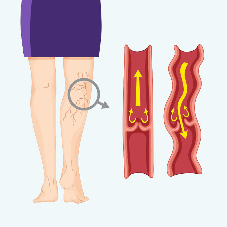 Illustration af et par ben med tydelige vener og til højre ses indersiden af en vene
